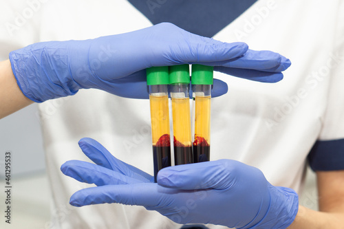 Close up Medic woman  hand in blue medical gloves holds 3 test tubes with blood plasma. Concert of laboratory blood tests and cosmetic injections for the beauty of skin and hair.