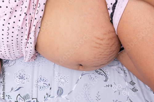 horizontal aerial shot of the belly of a pregnant woman with stretch marks