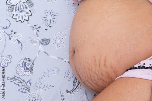 vertical shot of belly with stretch marks of pregnant woman