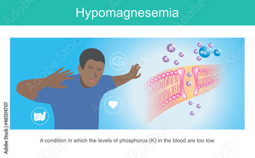 HYPOMAGNESEMIA. Illustration for showing symptoms a man condition in which the levels of phosphorus in blood are too low..