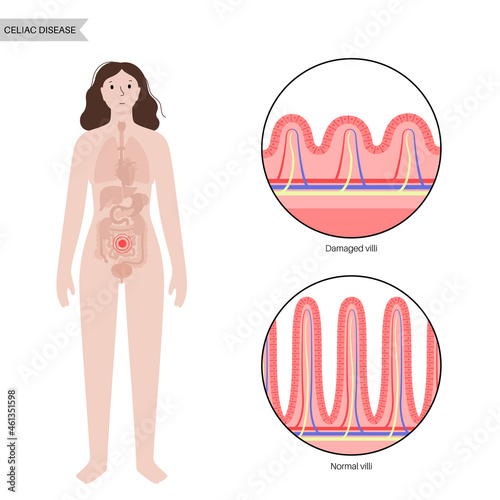 Celiac disease inflammation