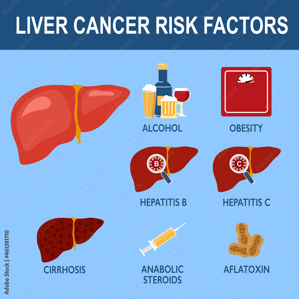 Liver cancer risk factors infographic vector illustration. Stock Vector ...