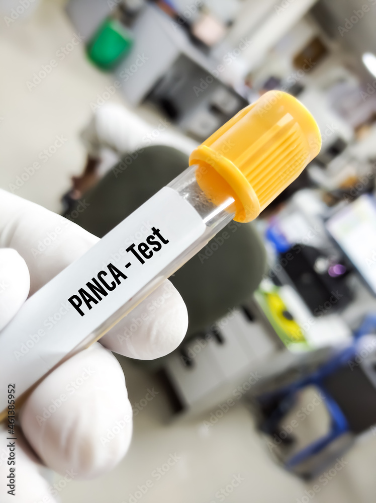 Scientist holds Blood samples for pANCA (perinuclear antineutrophil Scientist holds Blood samples for pANCA (perinuclear antineutrophil