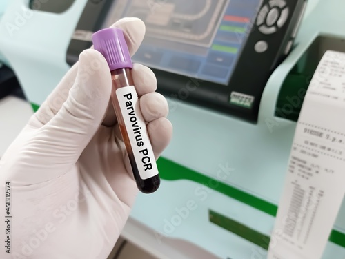 Biochemist or doctor holds blood sample for Parvovirus PCR test. Medical test tube in laboratory background.