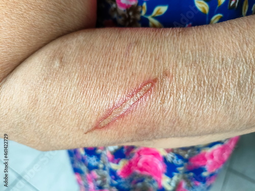 Burn wound from heat of diabetes.