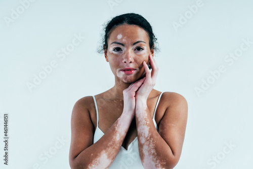 Beautiful woman with vitiligo skin posing in studio. Concept about body positivity and self acceptance photo