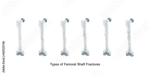 Types of Femoral Shaft Fractures photo