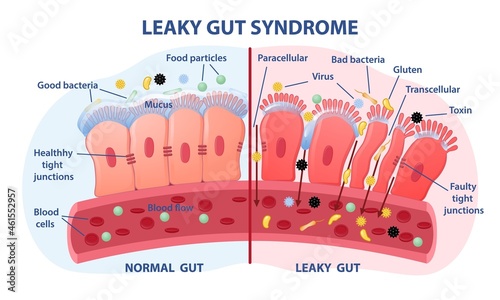 Leaky gut Syndrome concept. Comparison of healthy organ and inflamed tissue cells. Diseases of gastrointestinal tract. Toxins and viruses. Cartoon flat vector illustration isolated on white background photo
