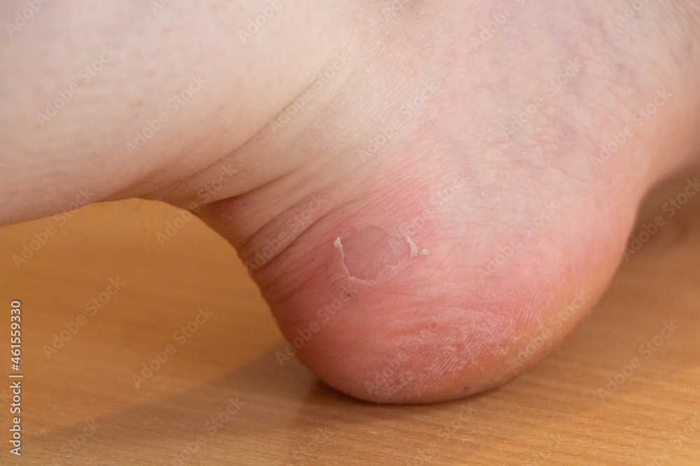 Naklejka premium Wound after a blister on the foot