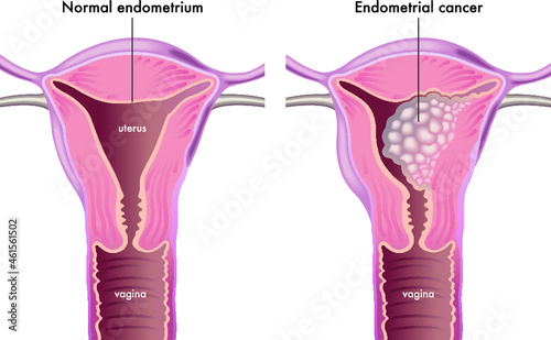 Medical illustration shows a female genital system with a normal endometrium compared with one afflicted of endometrial cancer.