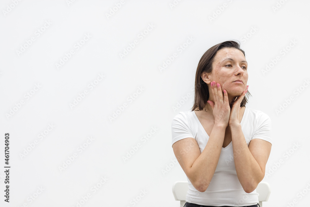 Photo of woman with dry skin touching her face on white background. Photo of woman with dry skin touching her face on white background.