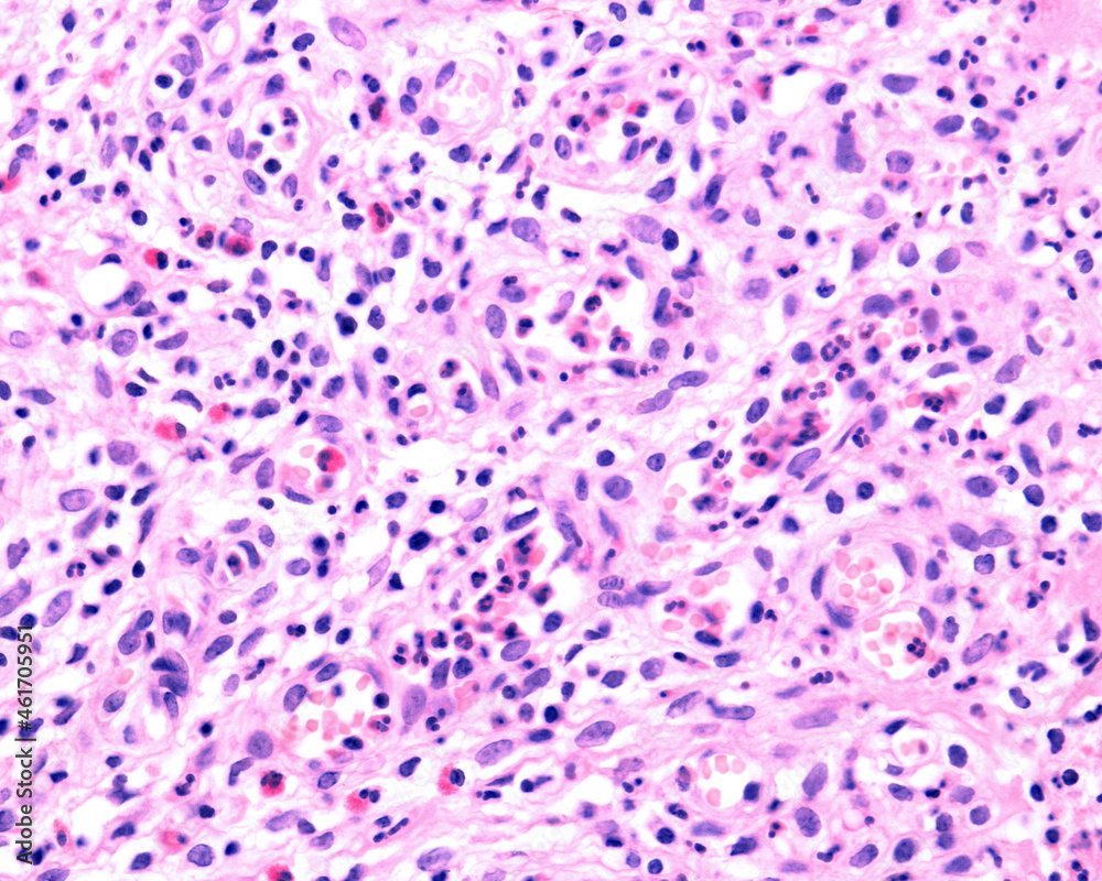 Inflammatory infiltrate Inflammatory infiltrate