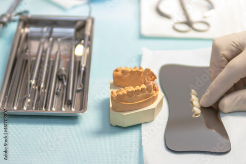 Anterior denture prosthesis for implant placement.