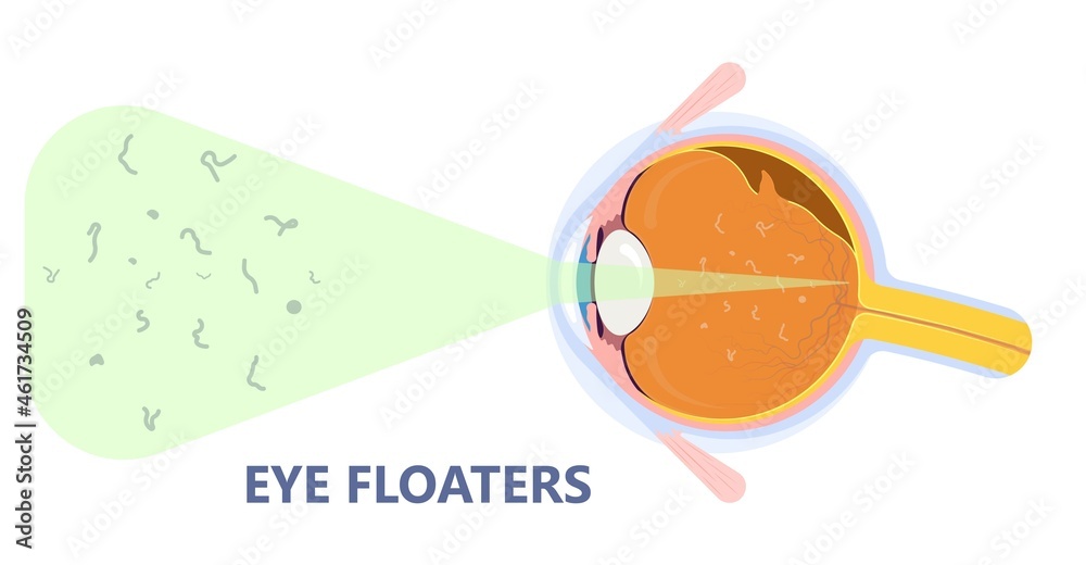 Eye Floaters Fluid Vision Retina Myopia Trauma Surgery Loss Of Light eye-floaters-fluid-vision-retina-myopia-trauma-surgery-loss-of-light