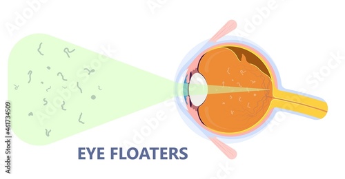 Eye floaters fluid vision retina myopia trauma surgery loss of light tear torn laser surgical repair older Detached blurry shadow Pain injury hole macular Age treat blood dark lose wear Pars Plana