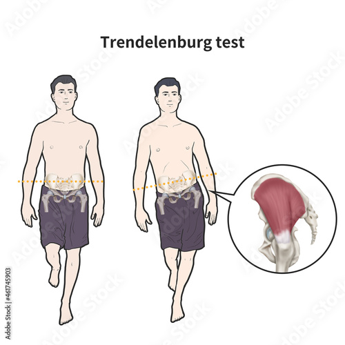 Trendelenburg test 검사. 중둔근 검사 photo