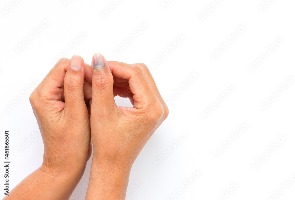 old woman hand compare right hand bleeding, bruising under a thumb nail that hurt by pressure from door,car door,falling things or ect.isolated on white background with copy space old woman hand compare right hand bleeding, bruising under a thumb nail that hurt by pressure from door,car door,falling things or ect.isolated on white background with copy space
