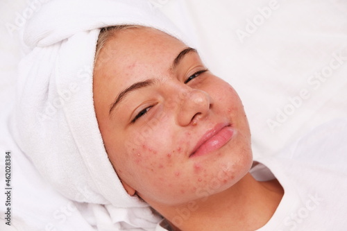 Acne. A smiling teenage girl with pimples on her face. Facial skin care.