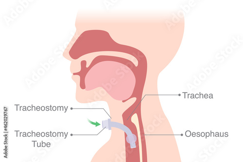The anatomy of a patient is intubated at the neck into the trachea to help breath. Medical Diagram about Tracheostomy is surgical at the airway system.