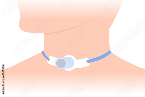 Tracheostomy tube at the patient neck who can not breathe with nose and mouth. Illustration about people has a Health Issues. Closeup.