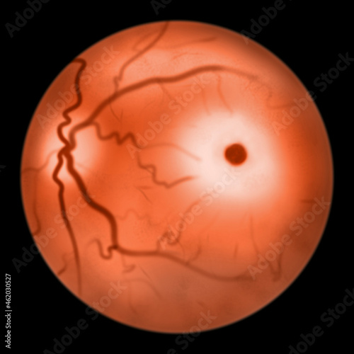 Eye retina in sphingolipid storage diseases, 3D illustration photo