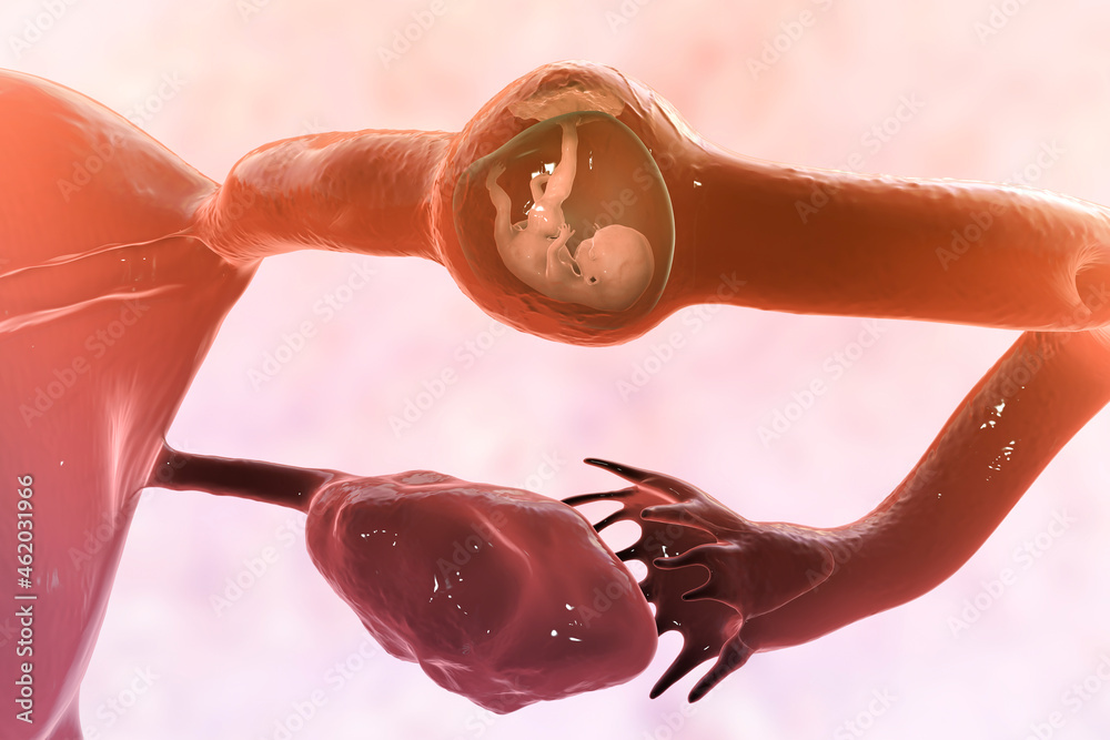 Tubal ectopic pregnancy, 3D illustration
