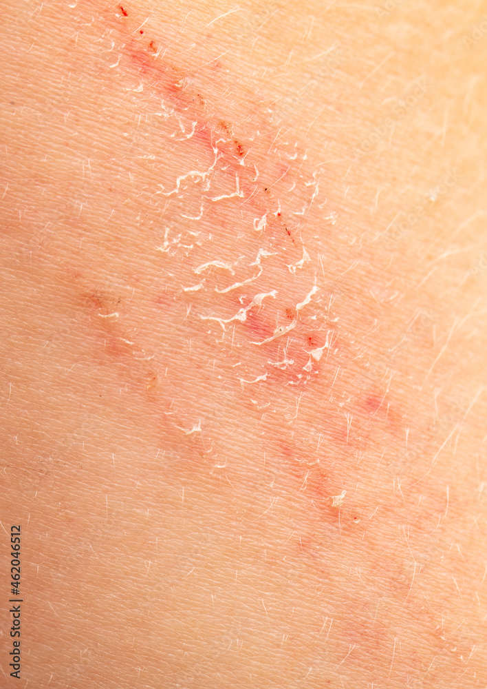 Fototapeta premium Wound scar on human skin.