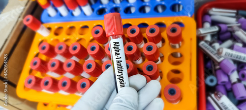 Scientist holds a blood sample tube for Alpha 1 antitrypsin(A1AT) Test. alpha-1 antitrypsin deficiency, COPD photo