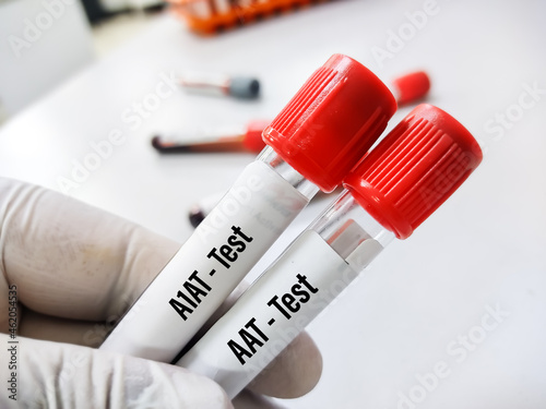Scientist holds a blood sample tube for Alpha 1 antitrypsin(A1AT) Test. alpha-1 antitrypsin deficiency, COPD