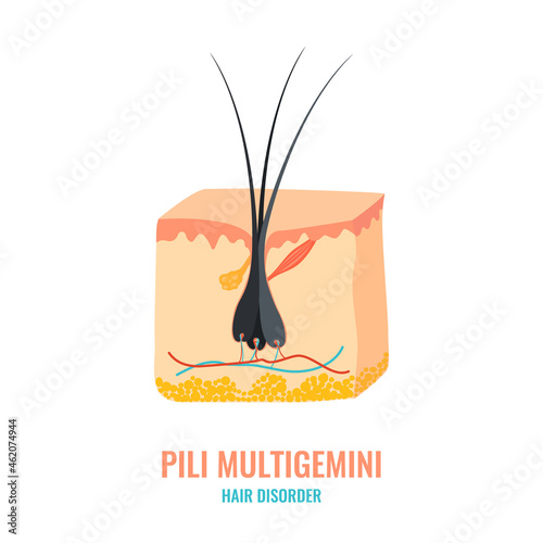 Pili multigemini hair disorder surface under microscope. Multiple hair shafts ingrowth condition closeup vector. Trichology medical concept.