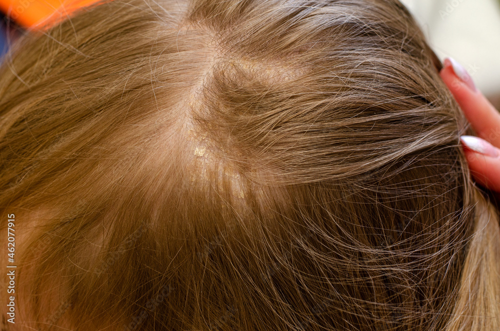 Dermatitis of the skin on the baby's head Dermatitis of the skin on the baby's head