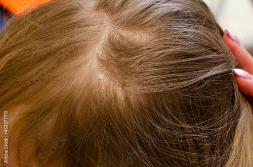 Dermatitis of the skin on the baby's head