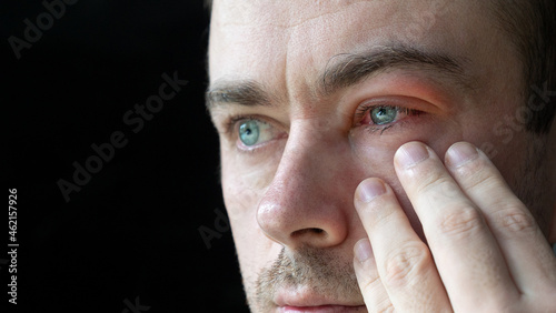 Close Up of Man Touch His Severe Bloodshot Red Blood Eye Affected by Conjunctivitis or After Allergy. Man with Viral Blepharitis, Conjunctivitis, Adenoviruses. Irritated, Infected Eye. Copy Space photo