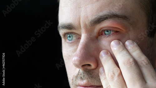 Close Up of Man Touch His Severe Bloodshot Red Blood Eye Affected by Conjunctivitis or After Allergy. Man with Viral Blepharitis, Conjunctivitis, Adenoviruses. Irritated, Infected Eye. Copy Space