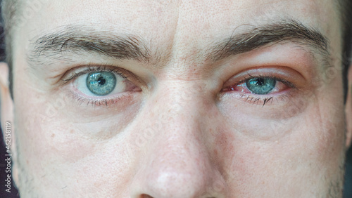 Photos Close Up of Severe Bloodshot Red Blood Eye of Male Affected by Conjunctivitis or After Allergy