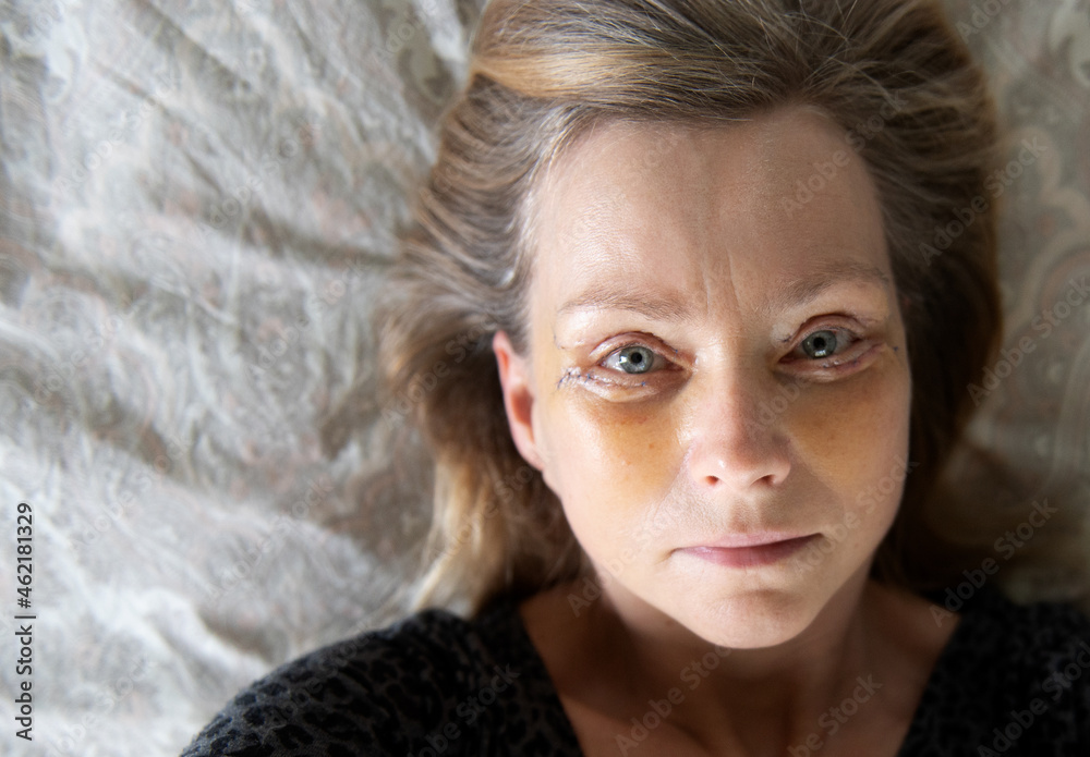 Middle-aged woman selfie seven days after Double Eyelid blepharoplasty surgery. Middle-aged woman selfie seven days after Double Eyelid blepharoplasty surgery.