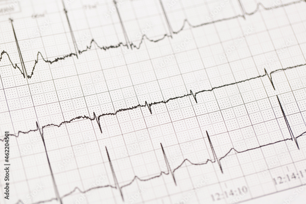 Close up of ECG, electrocardiogram. The work of a healthy heart on paper. Close up of ECG, electrocardiogram. The work of a healthy heart on paper.