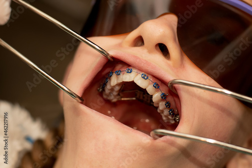 Mouth opened with dental retractors to show metal braces and teeth palatal expander. Orthodontic treatment. photo