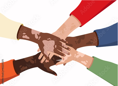 Vitiligo Community, pigmentation on the hands. The concept of different beauty, body positive, self-acceptance. Men, women, vitiligo skin disease.