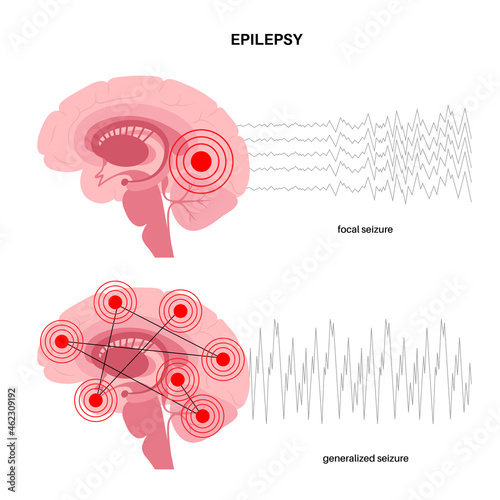epilepsy seizure concept