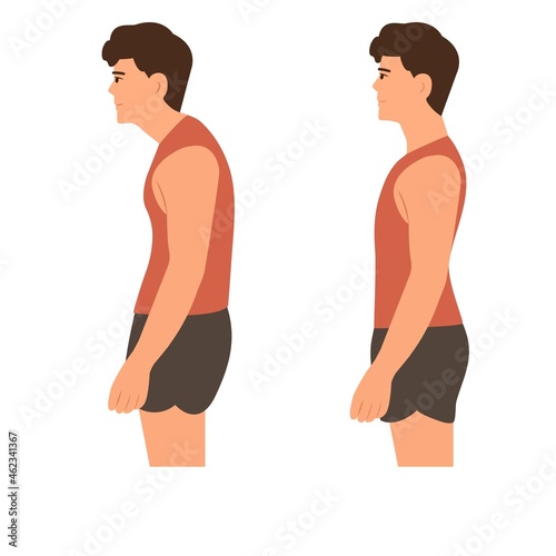 Correct and incorrect standing posture.Cervical spinal curvature. Hump. Healthy back.Vector illustration on white background.