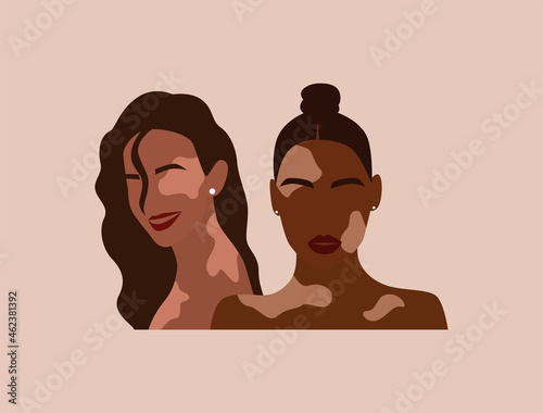 Two women with vitiligo of different nationalities together.Abstract faceless potrait of female. Pigmentation dermatology disease concept. Modern flat vector illustration