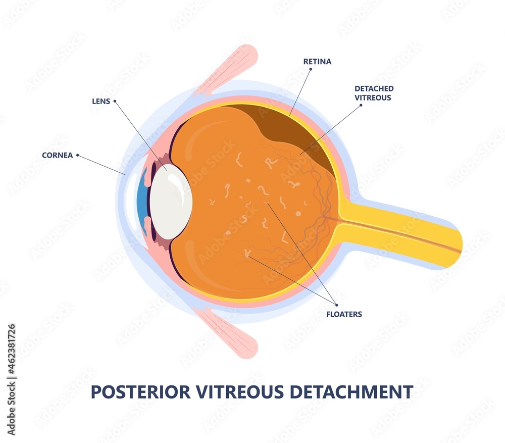 Eye floaters fluid vision retina myopia trauma surgery loss of light ...