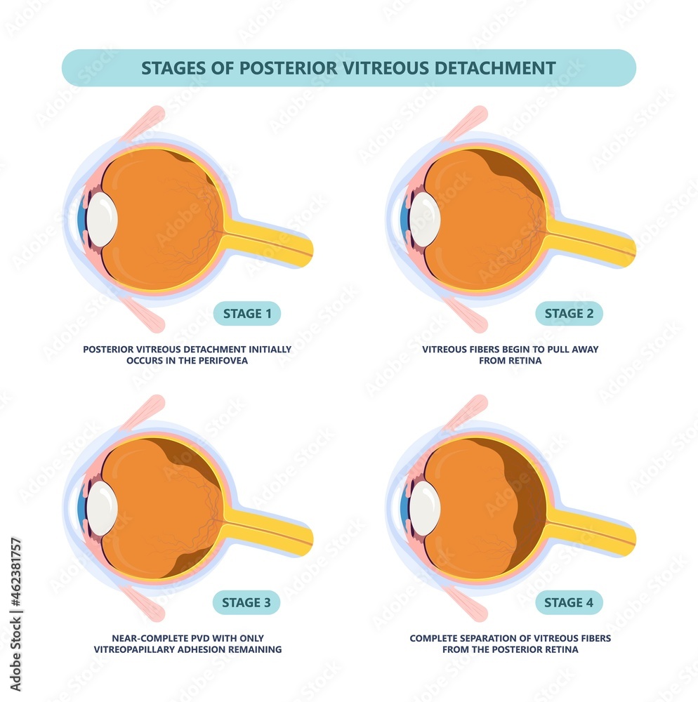 Eye floaters fluid vision retina myopia trauma surgery loss of light