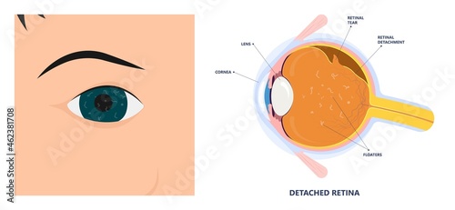 Eye floaters fluid vision retina myopia trauma surgery loss of light tear torn laser surgical repair older Detached blurry shadow Pain injury hole macular Age treat blood dark lose wear Pars Plana