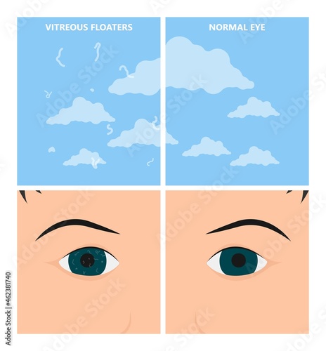 Eye floaters fluid vision retina myopia trauma surgery loss of light tear torn laser surgical repair older Detached blurry shadow Pain injury hole macular Age treat blood dark lose wear Pars Plana