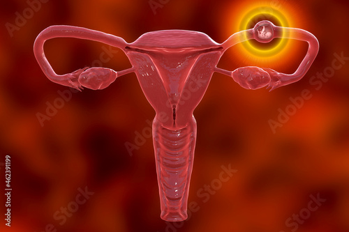Tubal ectopic pregnancy, 3D illustration photo