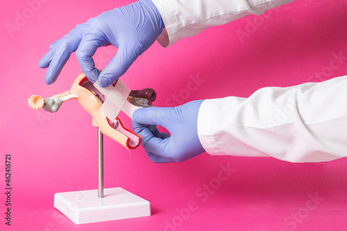 The doctor holds a cross from a medical plaster in medical gloves on a pink background. Concept for the treatment of intimate problems in a girl, vaginal polyp photo