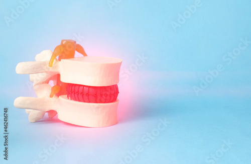 Mock up of a human spine with an inflamed intervertebral hernia on a blue background. Copy space for text photo