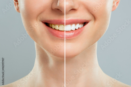 woman teeth before and after whitening. Over white background. Dental clinic patient. Image symbolizes oral care dentistry, stomatology